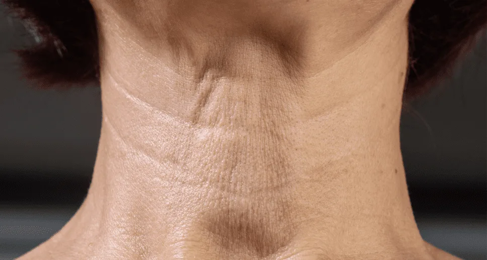 Loose Hyoid Skin