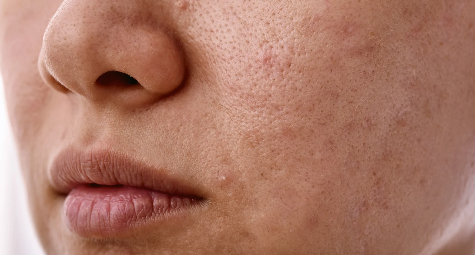 Skin Tags removed