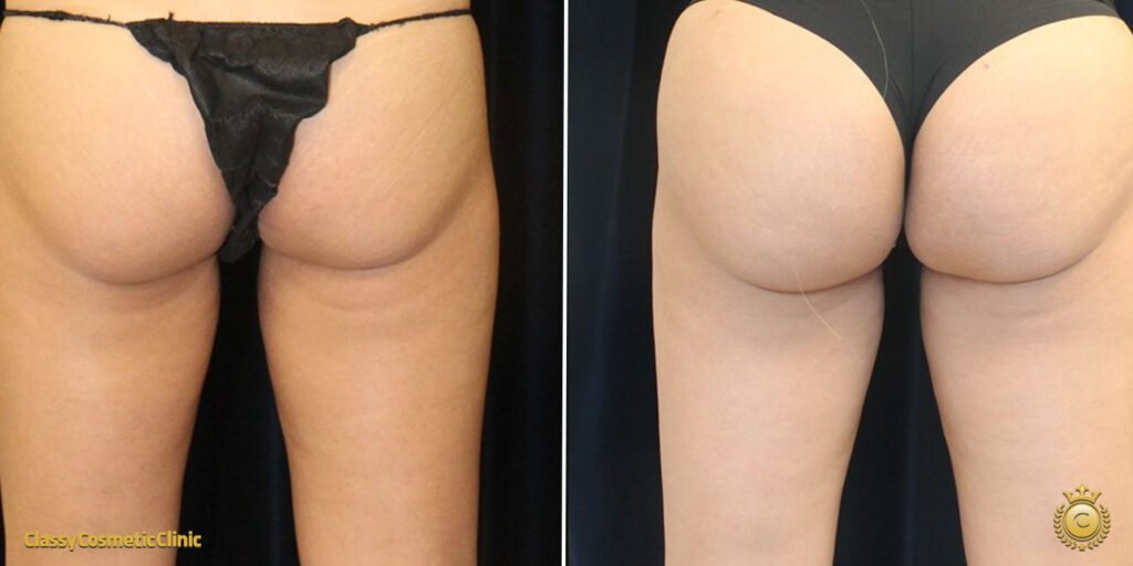 Buttock Injections Near Me – Find the Best Locations for Your Treatment