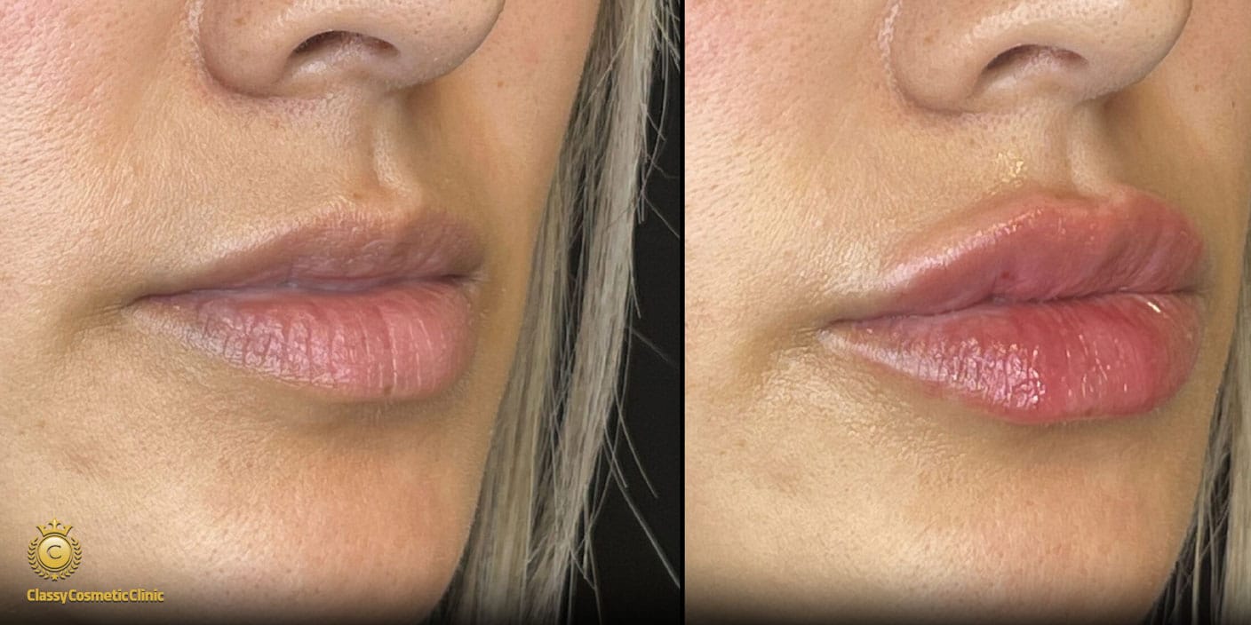 Complete Lip Filler Guide Best Practices For Lip Enhancement