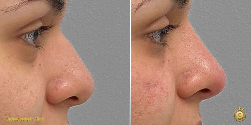 Nose Filler