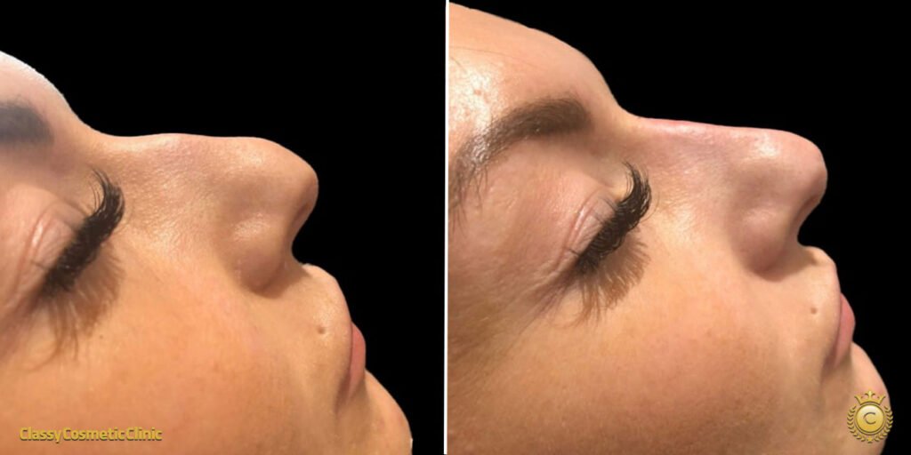 nose-filler-injection-before-and-after-3