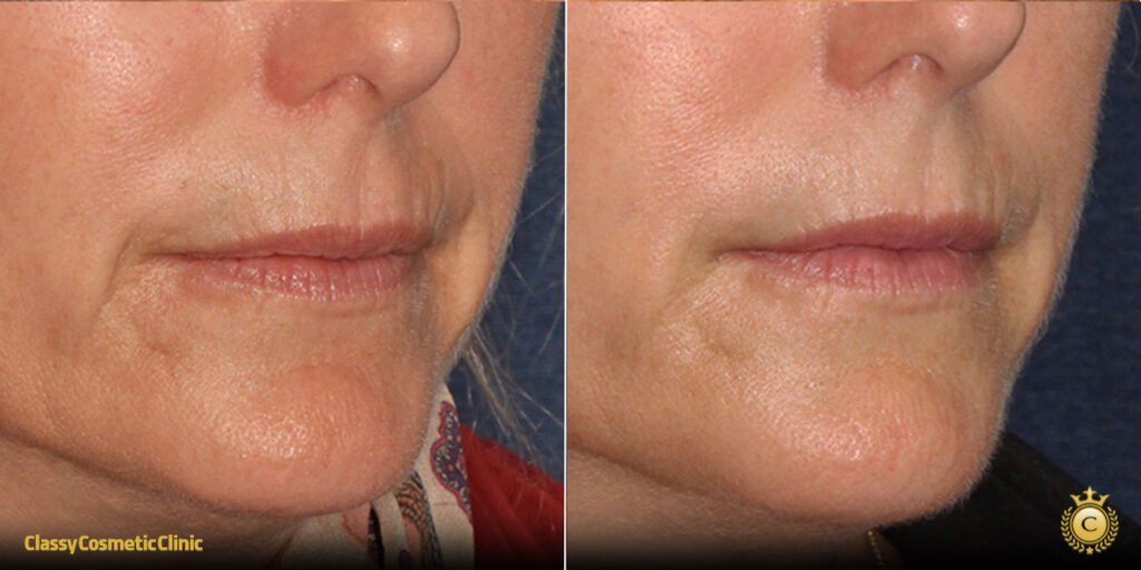 Ultherapy Perioral before and after