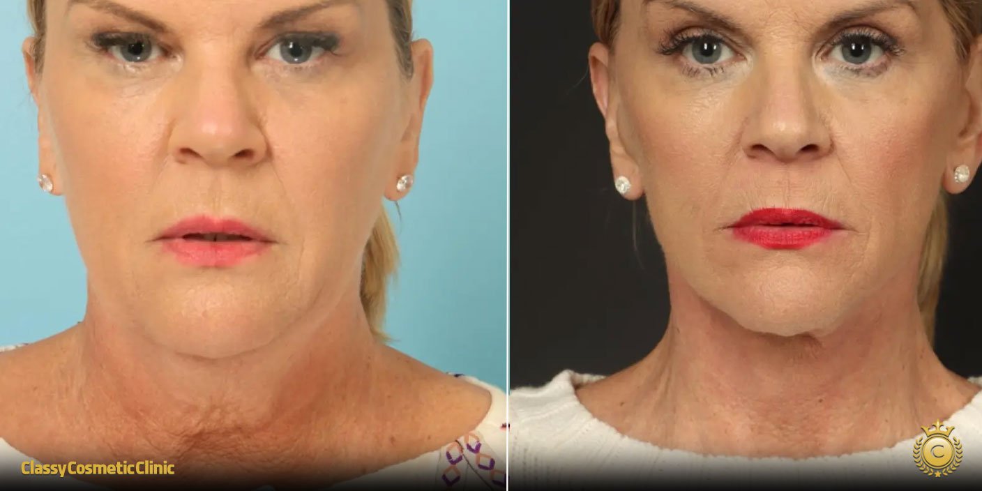 Ultherapy Perioral before and after