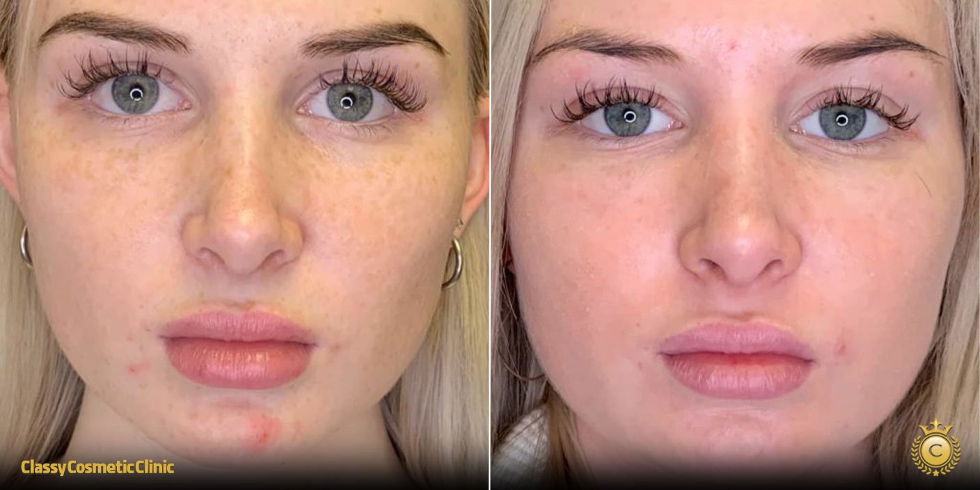 PRP for Facial Rejuvenation before and after