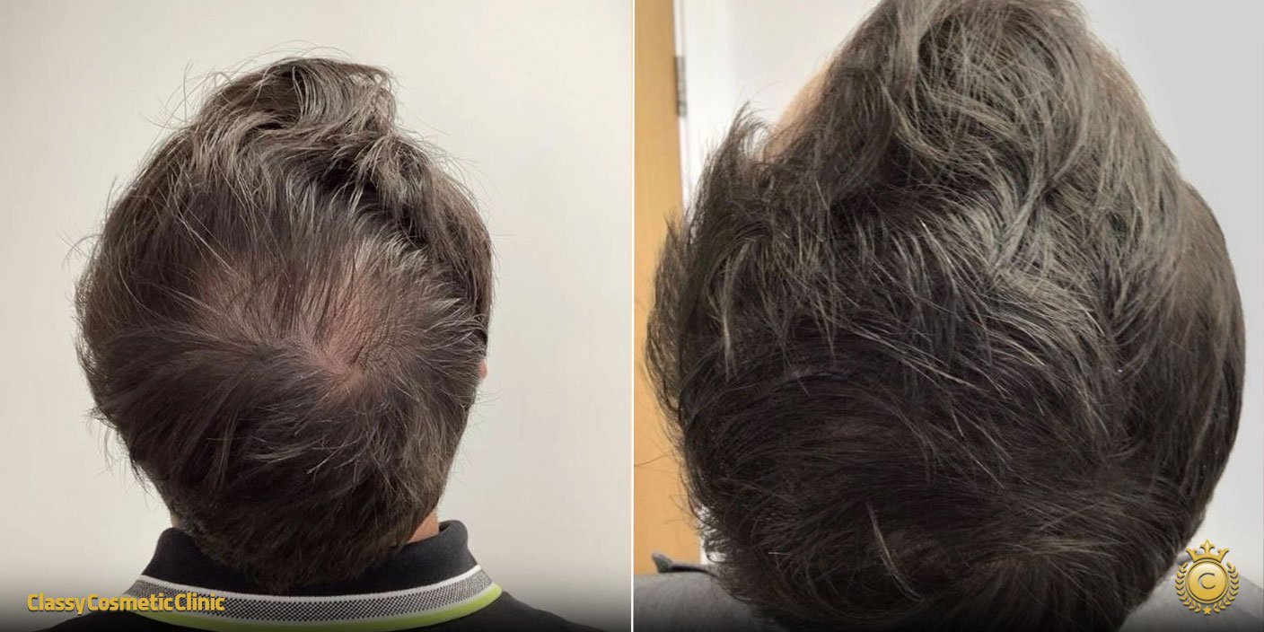 prp therapy markham before and after