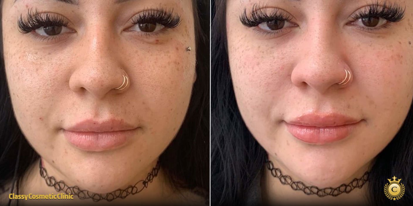 prp vampire facial before and after
