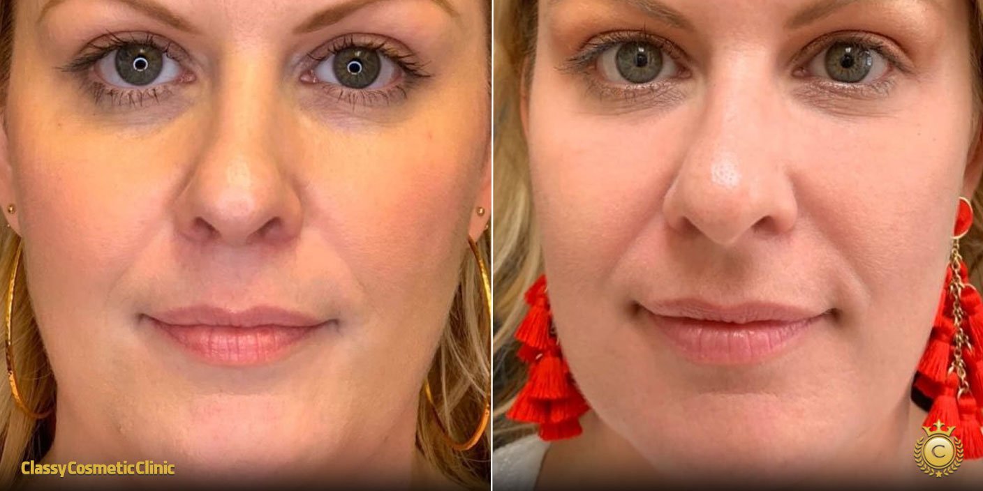 prp vampire facial before and after