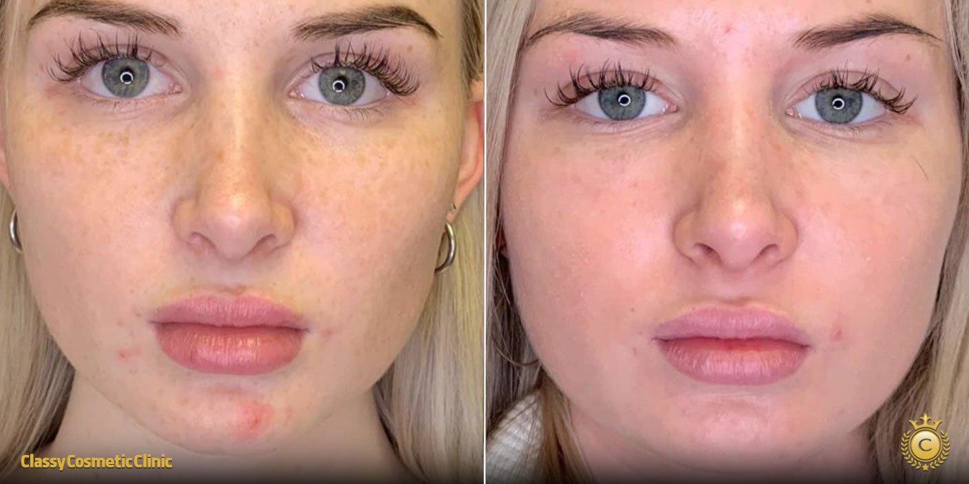 prp vampire facial before and after