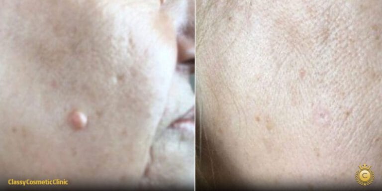 Get Rid of Moles on Your Face Forever: Long-Lasting Methods