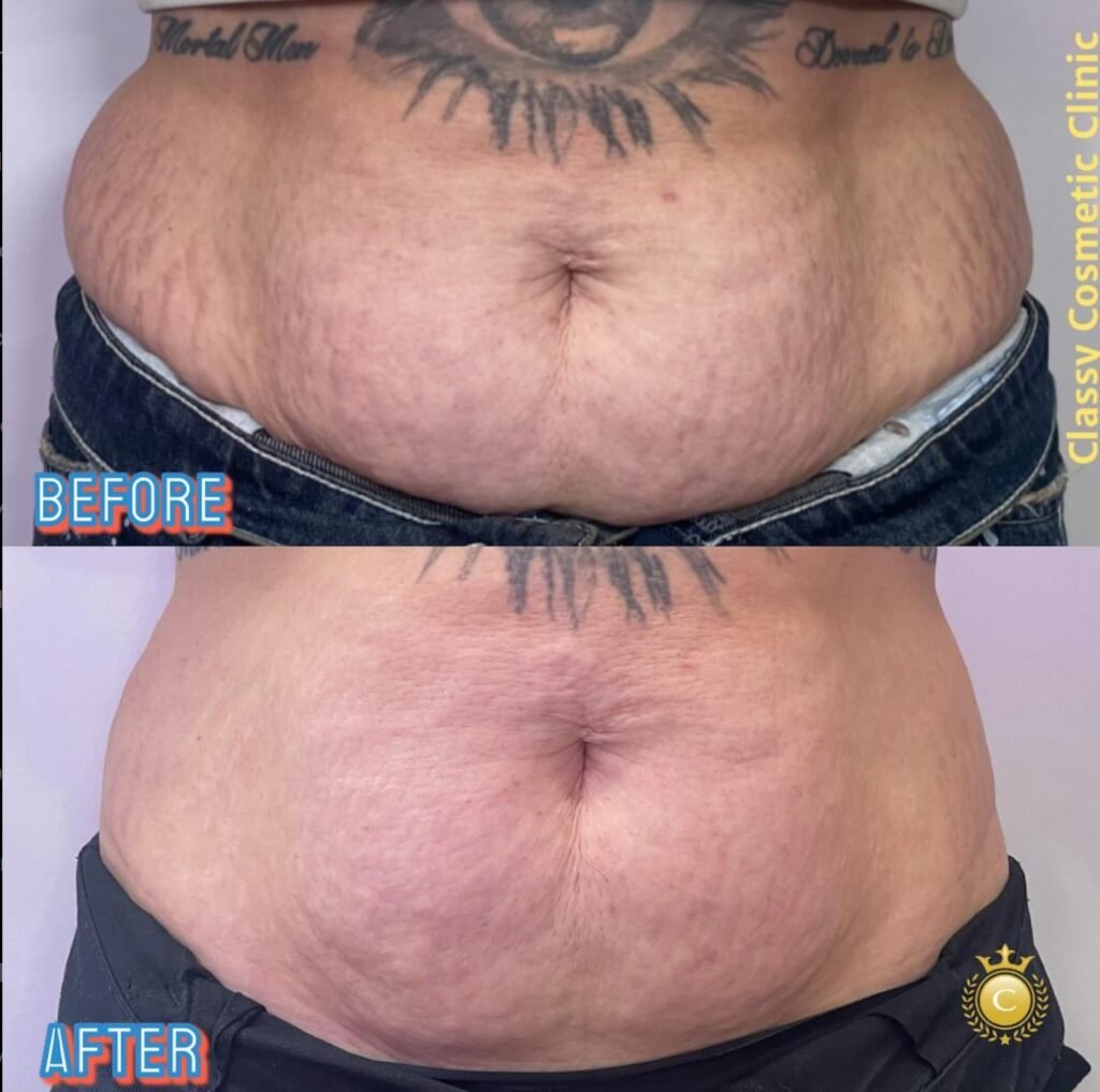 fat dissolving injection before and after photo