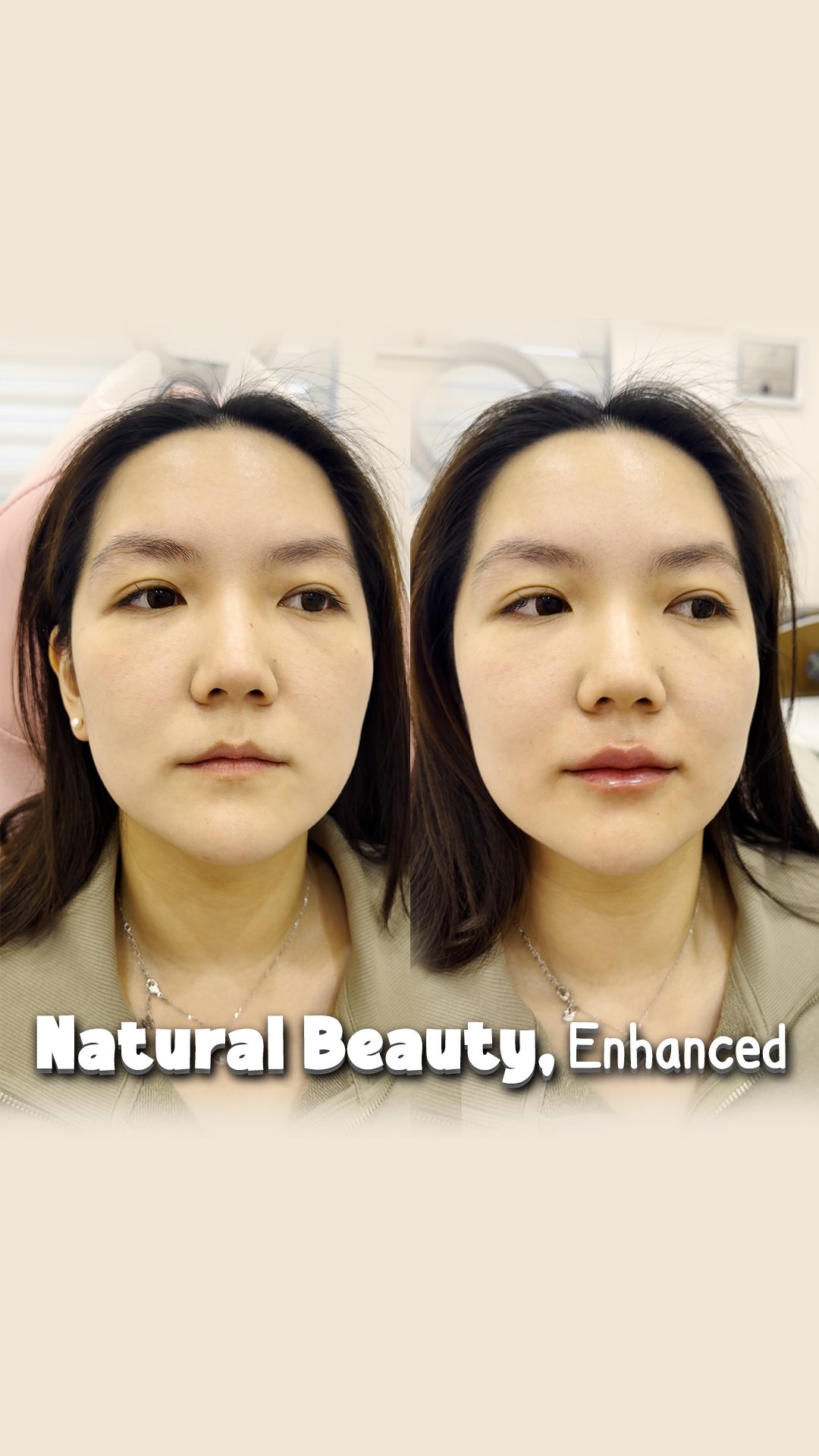 Natural beauty enhanced - lip filler near me - lip filler before and after