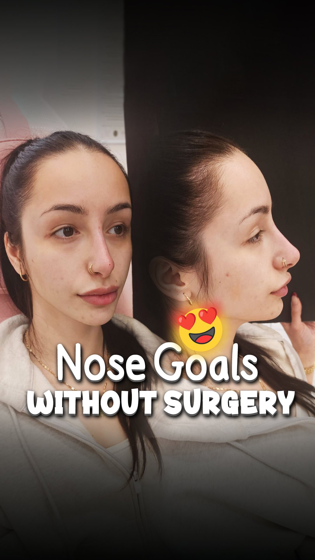 Nose goals withiut surgery
