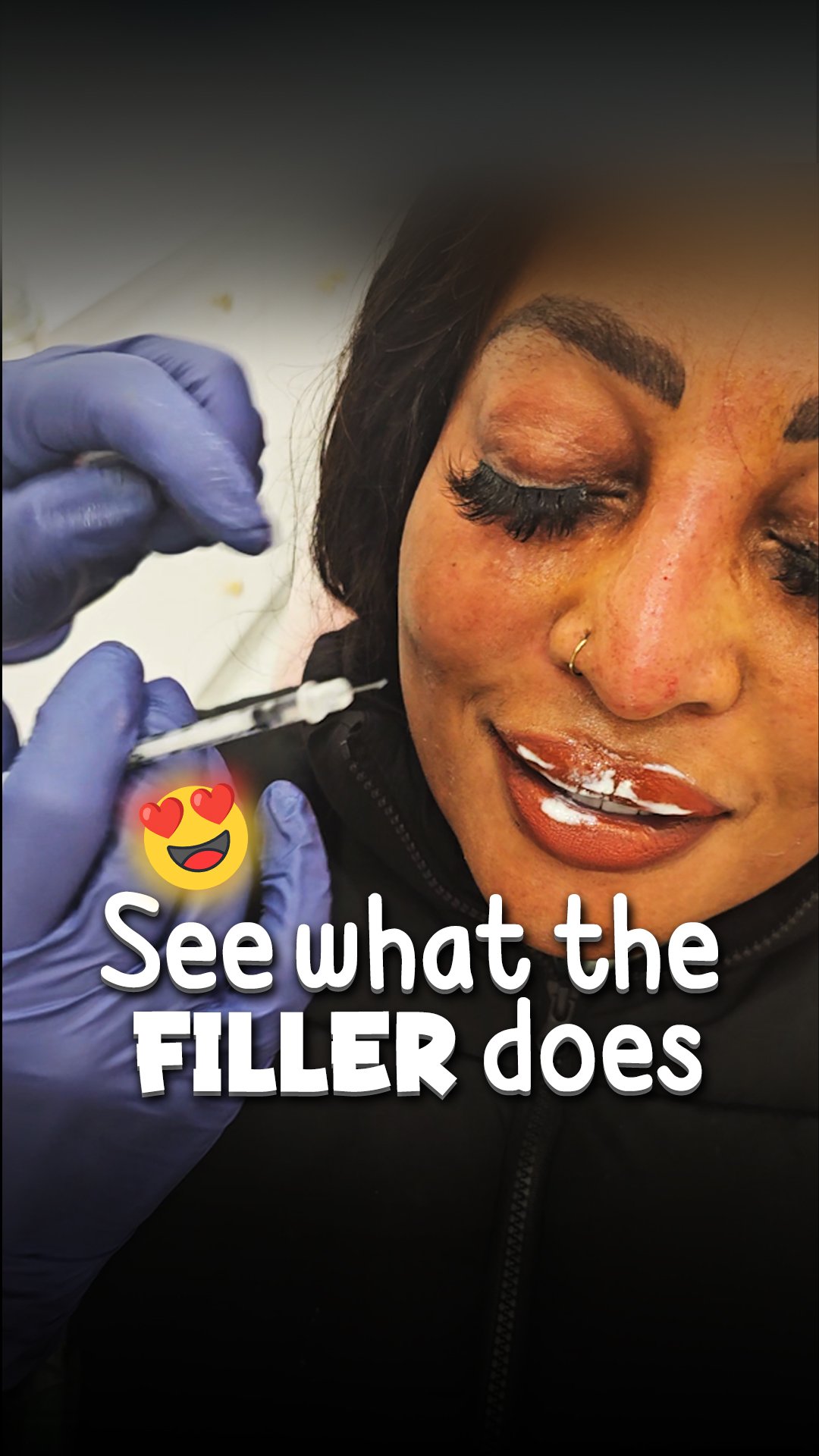 See what filler does - lip filler - nose filler - face filler