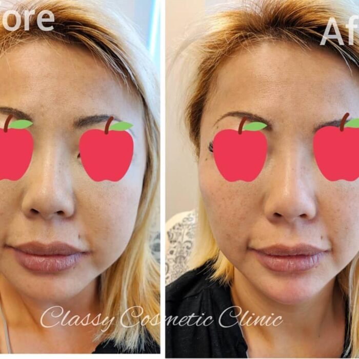facial contouring - facial filler - face lift