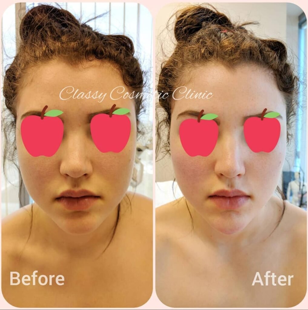 facial contouring - facial filler - face lift