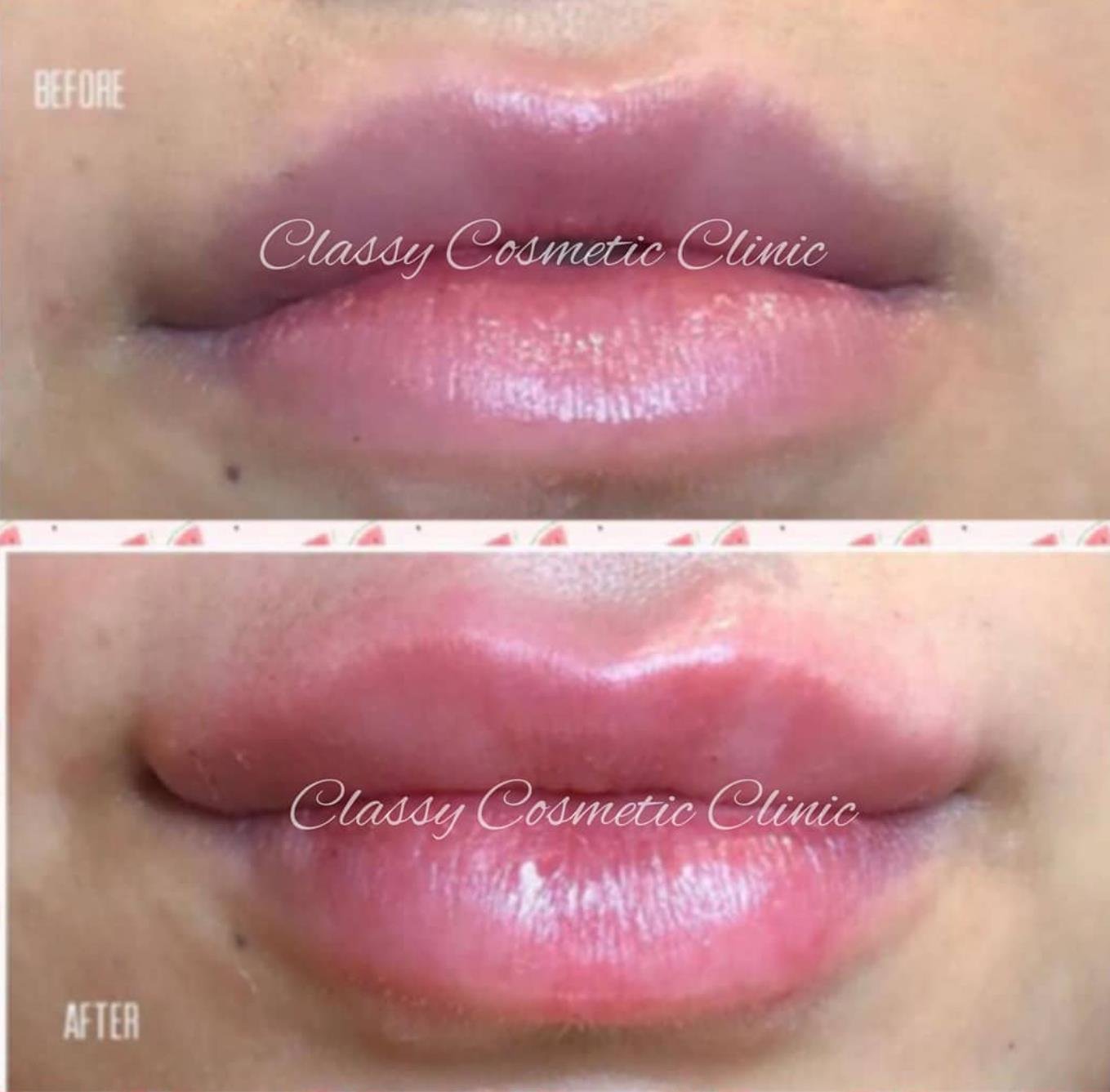 lip filler injection before and after