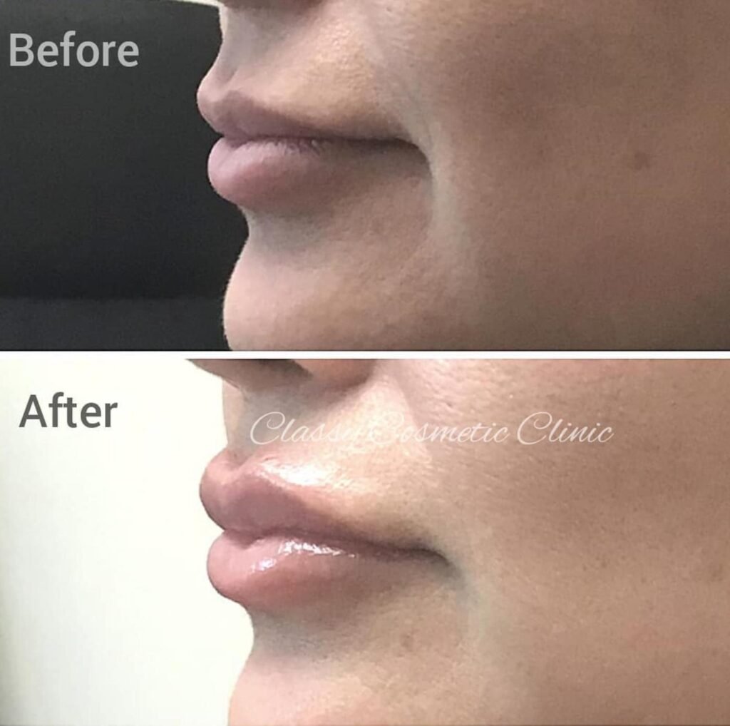 lip filler injection before and after