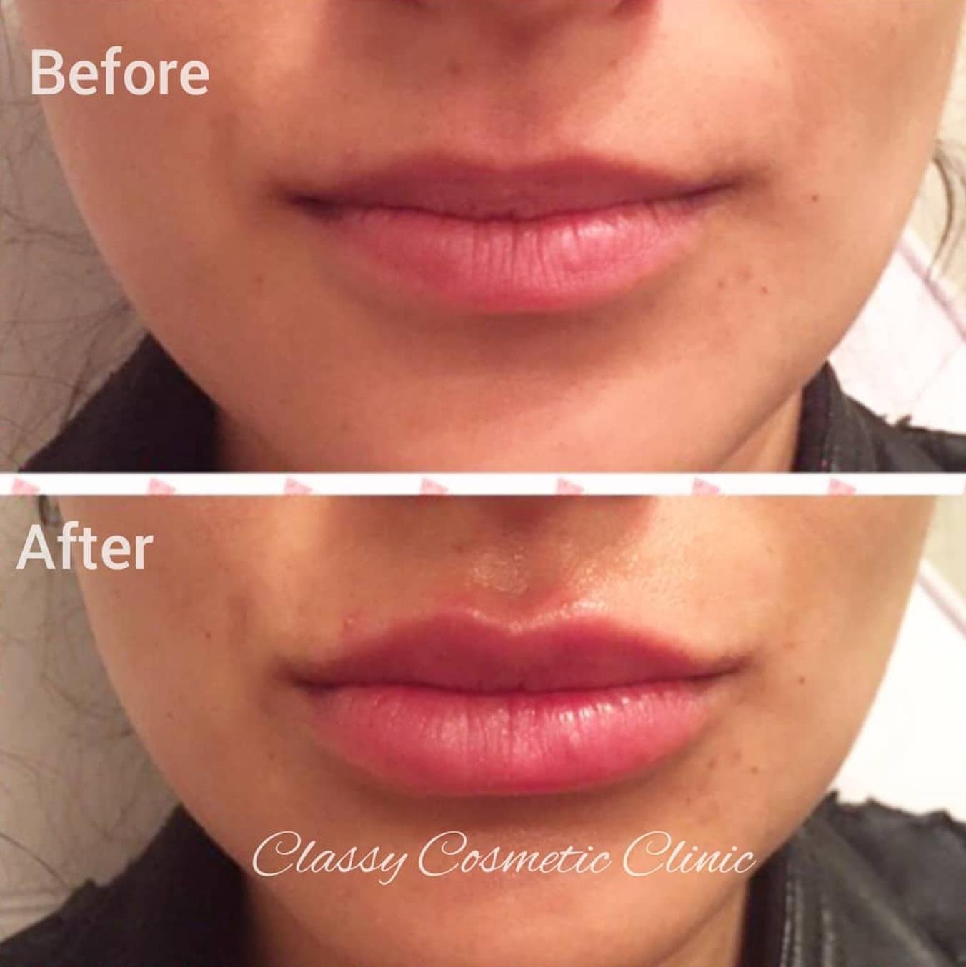 lip filler injection before and after
