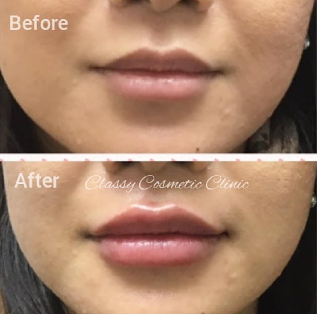 lip filler injection before and after