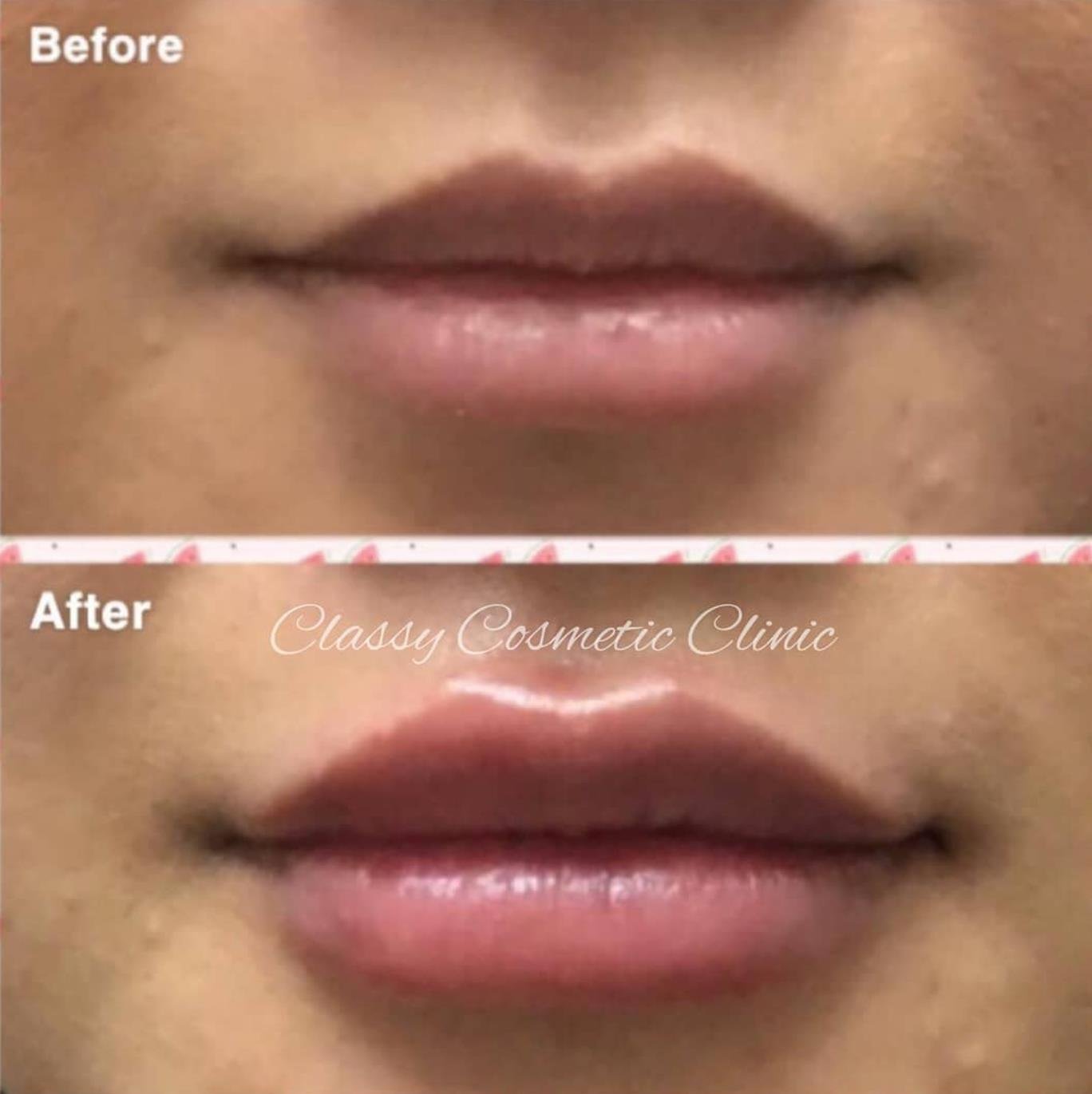 lip filler injection before and after