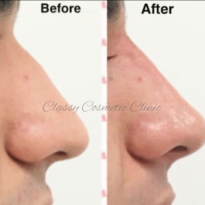 nose filler - before and after - rhinoplasty