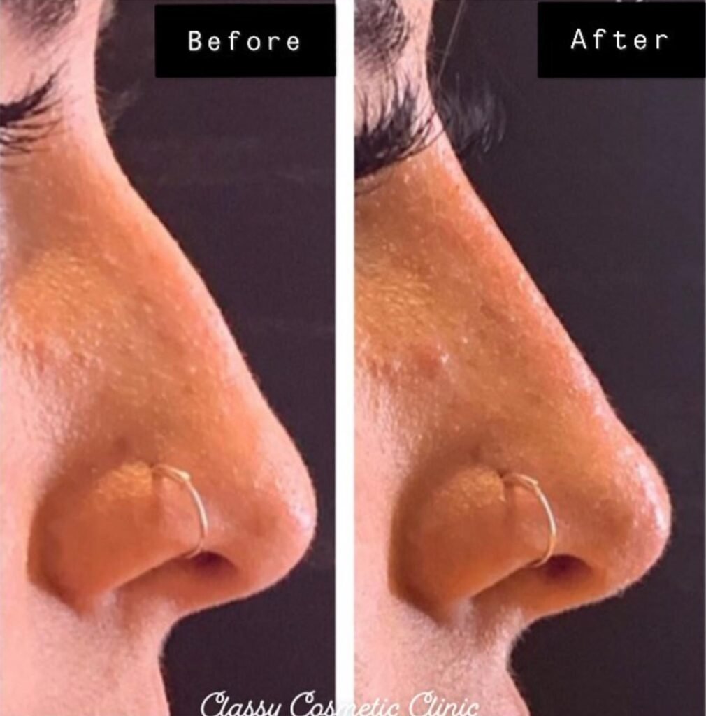 nose filler - before and after - rhinoplasty