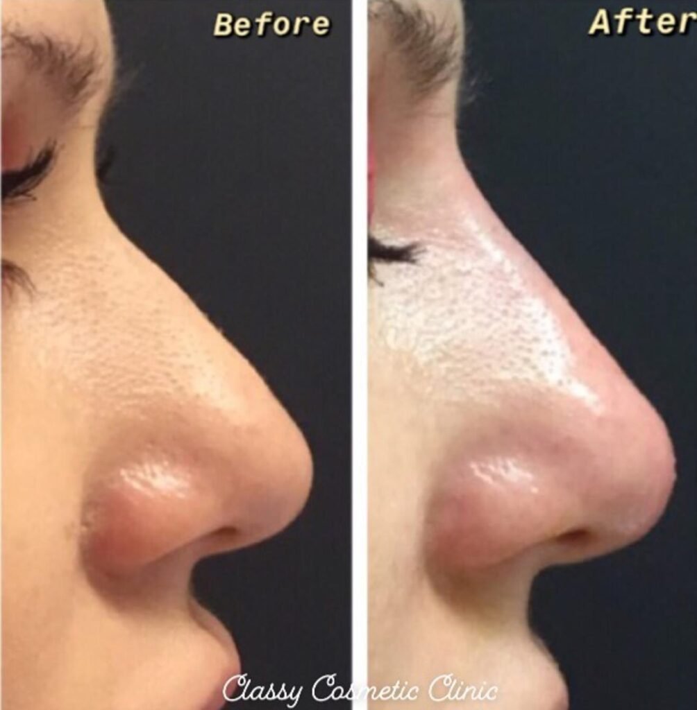nose filler - before and after - rhinoplasty