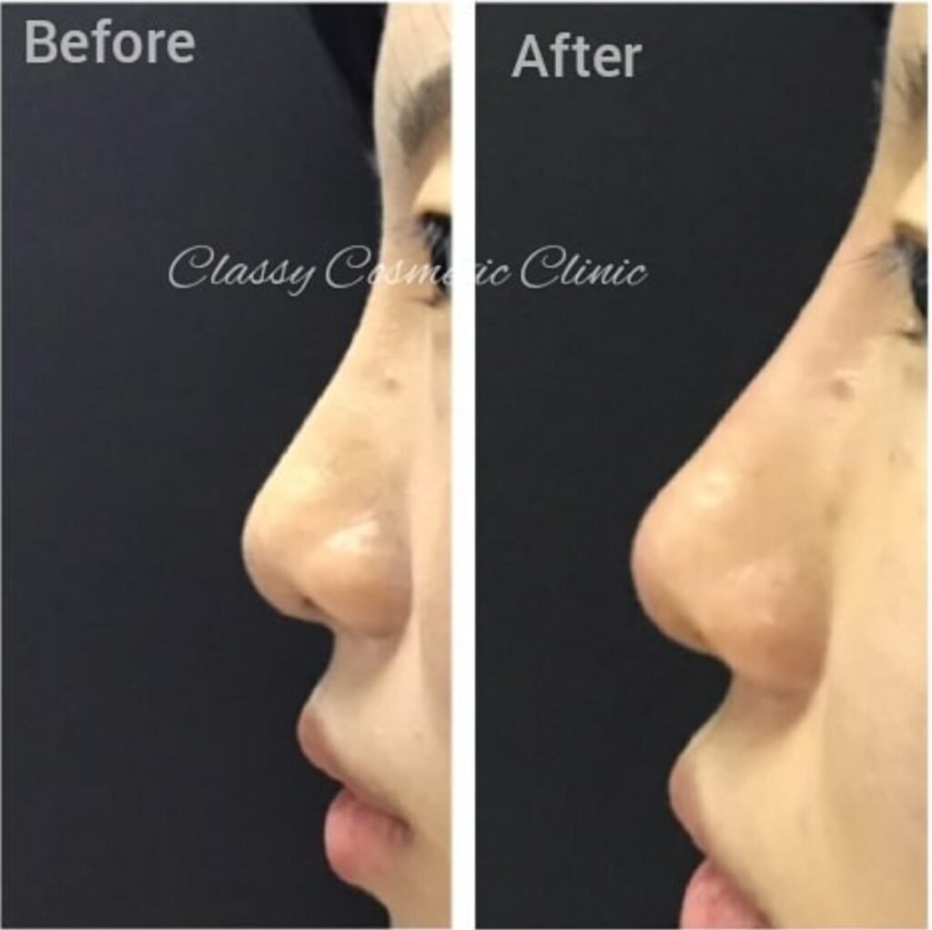 nose filler - before and after - rhinoplasty