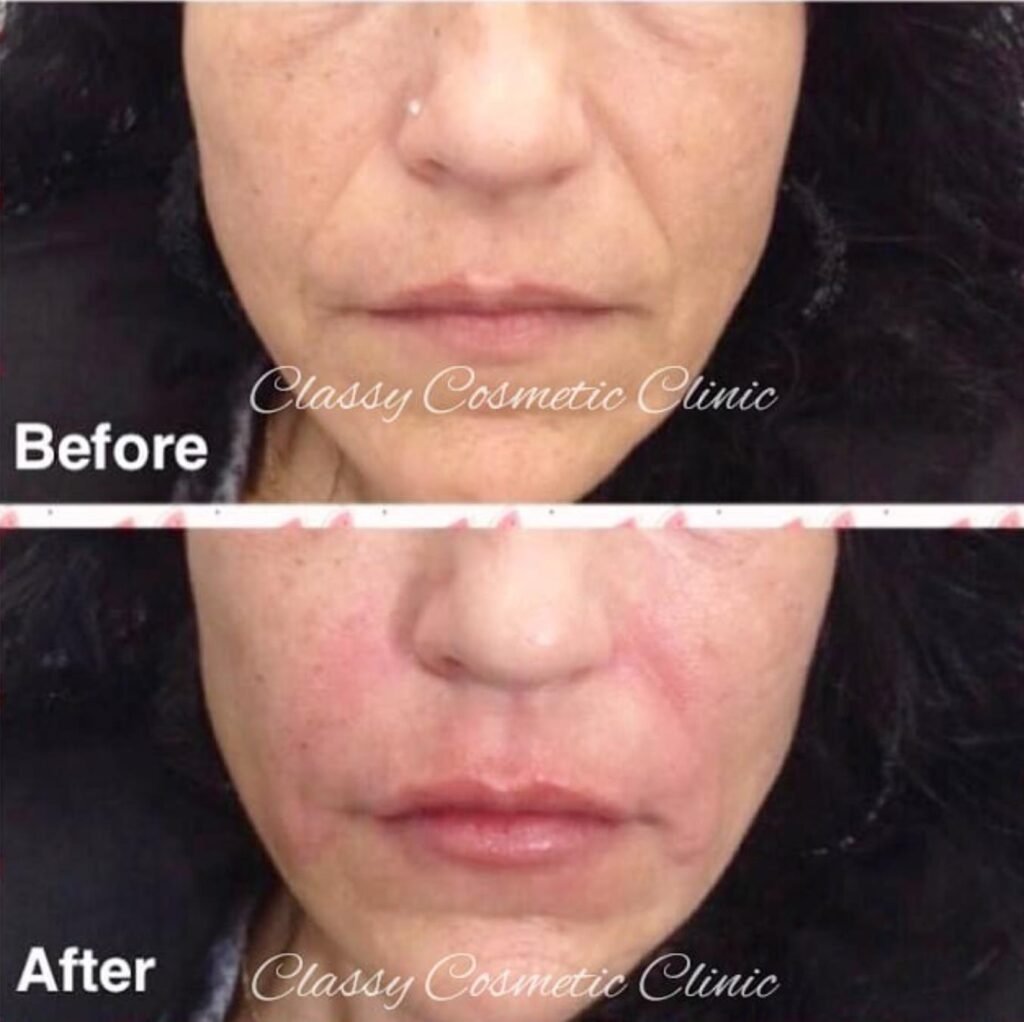nasolabial fold fillers before and after smile line filler