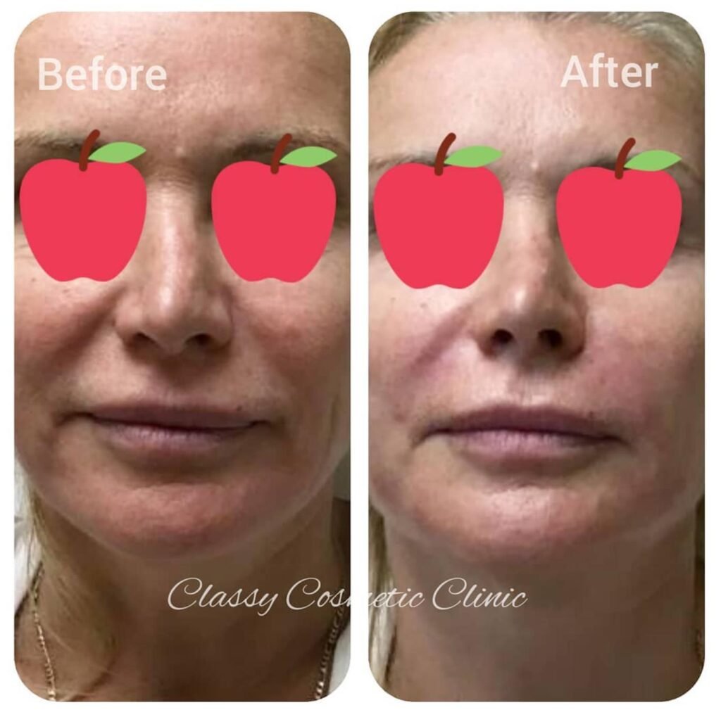 nasolabial fold fillers before and after smile line filler
