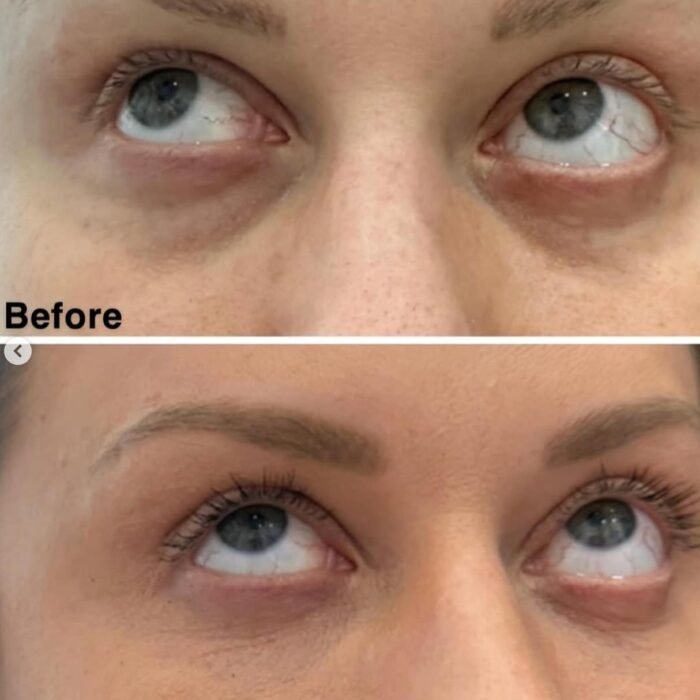 Under eye filler before and after photo