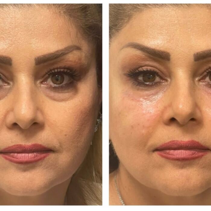 Under eye filler before and after photo