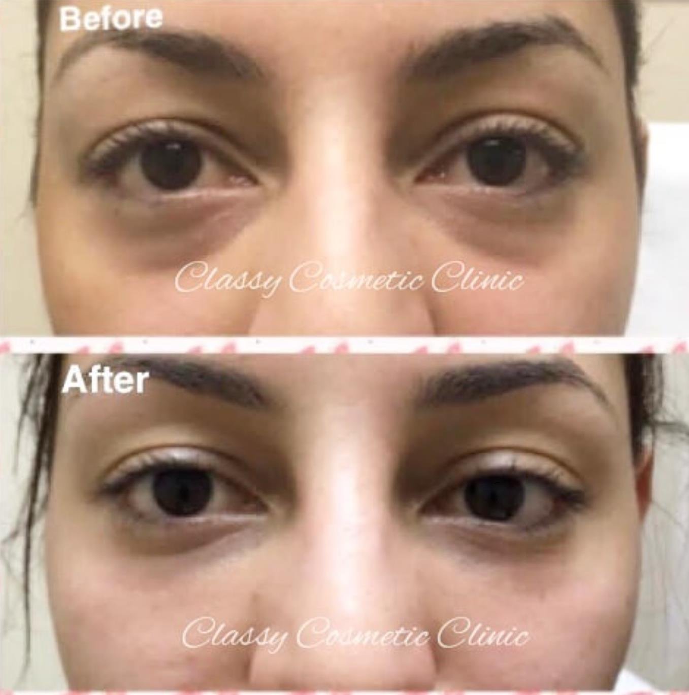 under eye filler