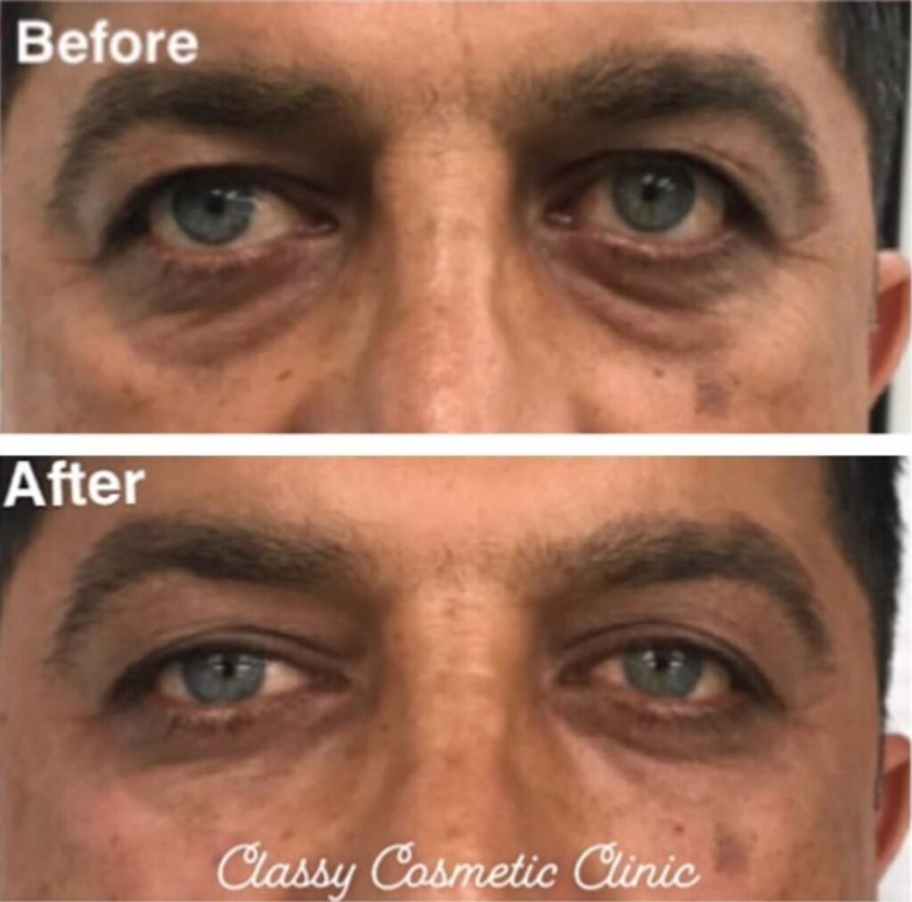 Under eye filler before and after photo