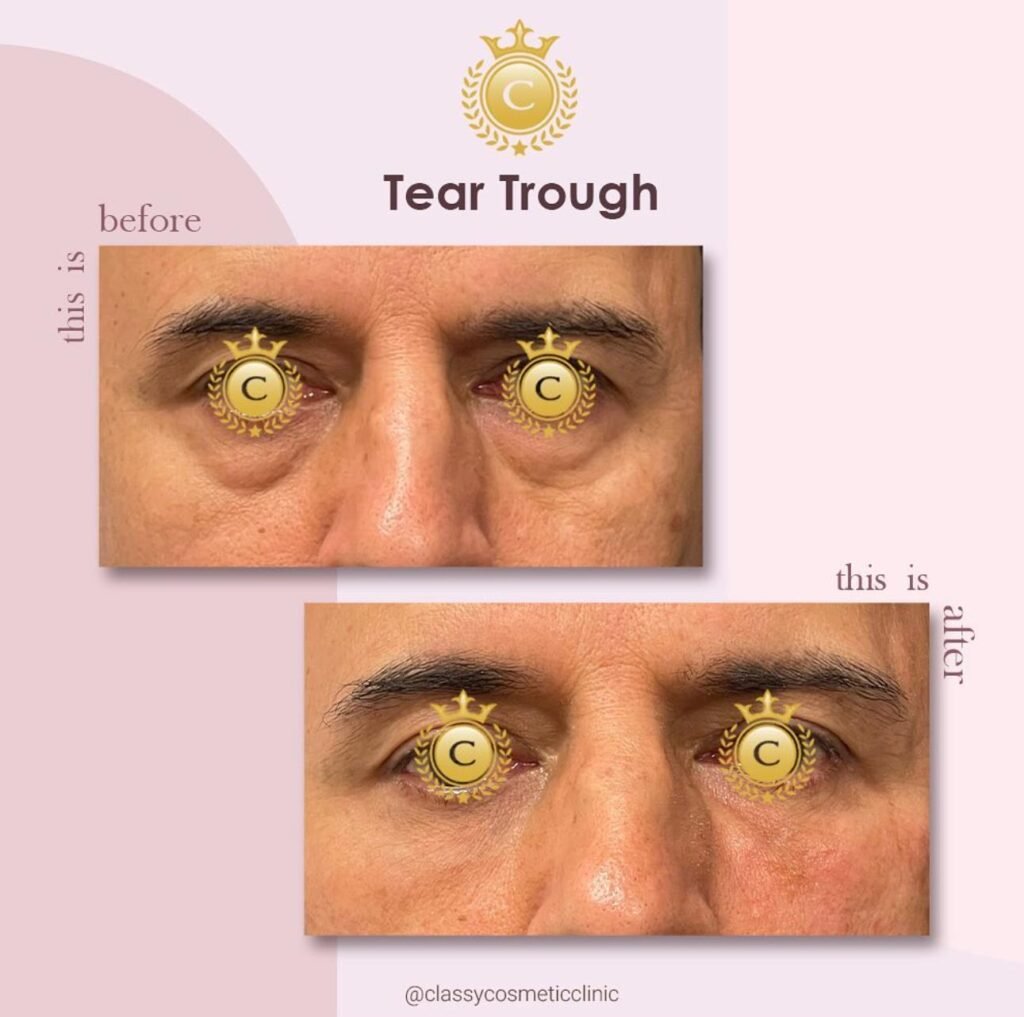 Under eye filler before and after photo