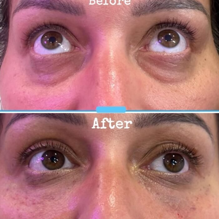 Under eye filler before and after photo