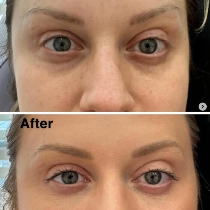 Under eye filler before and after photo