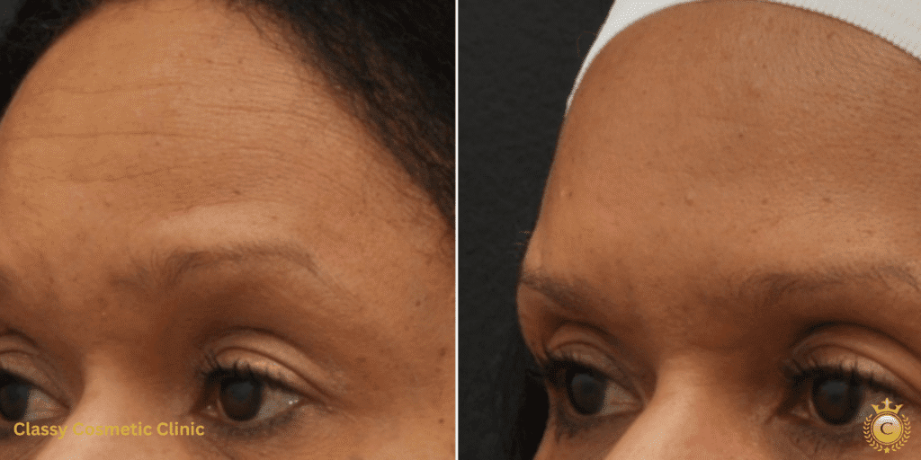 dysport dysport near me - dysport treatment botox injections near me