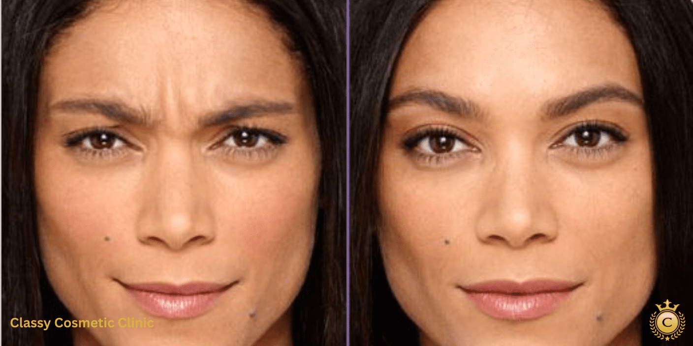 dysport dysport near me - dysport treatment botox injections near me