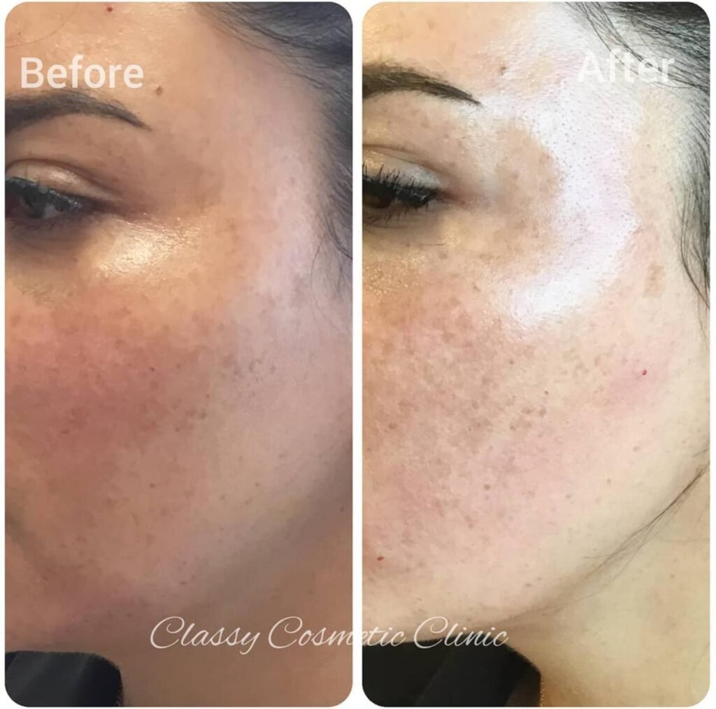 Jawline Non Surgical Contouring before and after - jawline filler