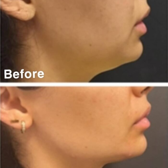 Jawline Non Surgical Contouring before and after - jawline filler