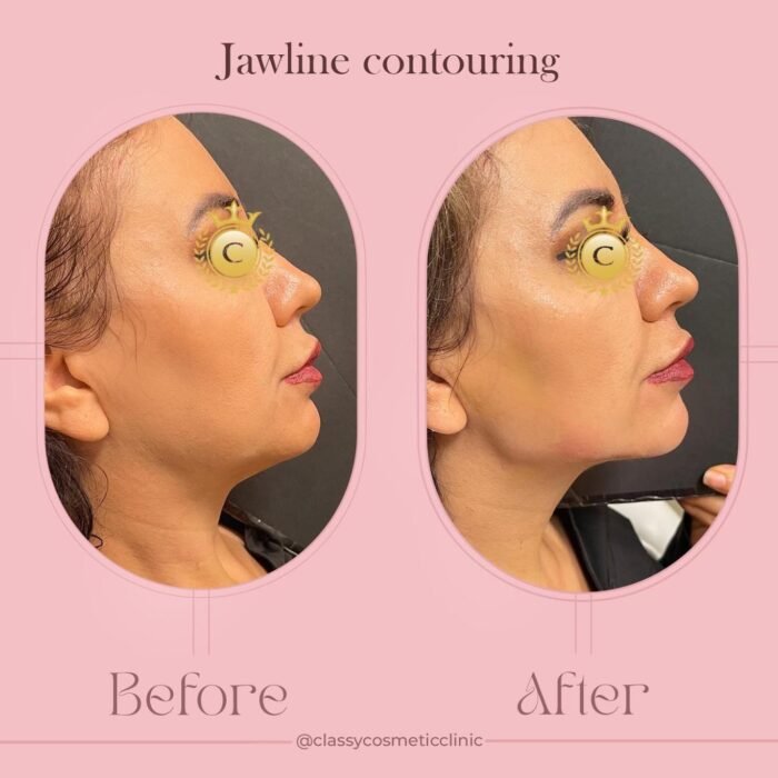 Jawline Non Surgical Contouring before and after - jawline filler