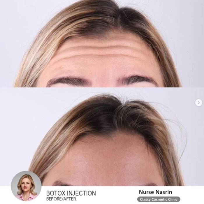 botox injection before and after