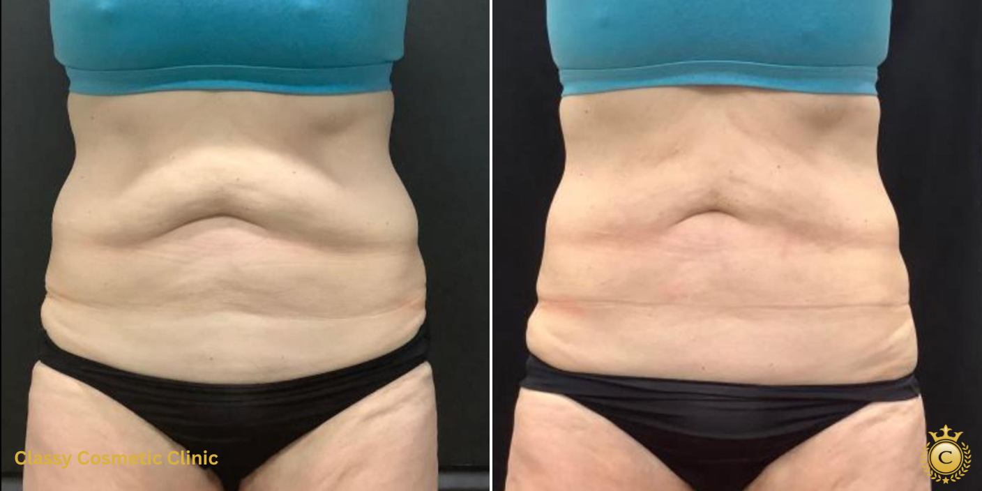 CoolSculpting near me SculpSure SculpSure Near me CoolSculpting vs SculpSure body contouring body contouring Markham fat freezing