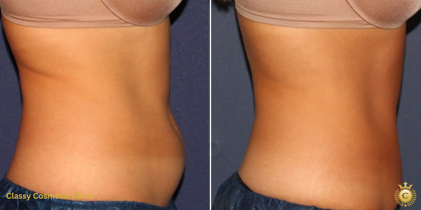 CoolSculpting CoolSculpting near me SculpSure SculpSure Near me CoolSculpting vs SculpSure